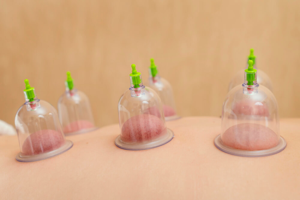 cupping