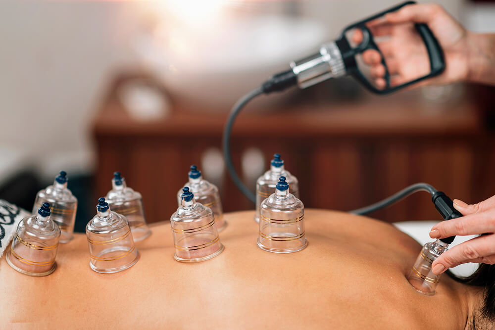 Dry Cupping